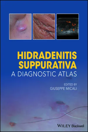 Hidradenitis Suppurativa