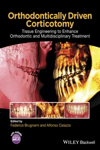 Orthodontically Driven Corticotomy_cover