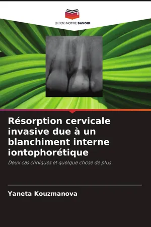 Résorption cervicale invasive due à un blanchiment interne iontophorétique