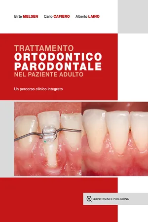  Trattamento ortodontico parodontale nel paziente adulto