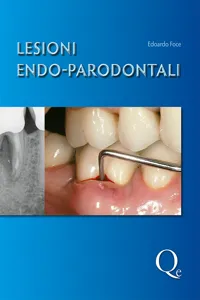 Lesioni endo-parodontali_cover