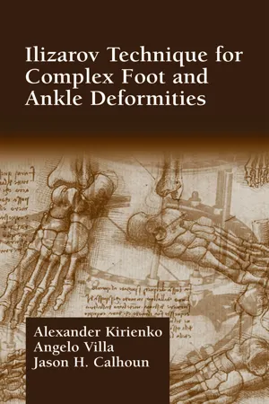 Ilizarov Technique for Complex Foot and Ankle Deformities