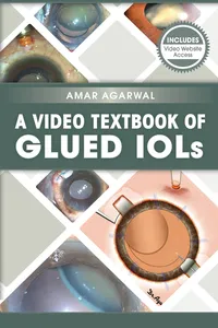 A Video Textbook of Glued IOLs_cover