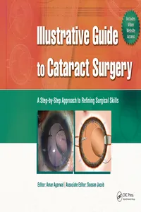 Illustrative Guide to Cataract Surgery_cover